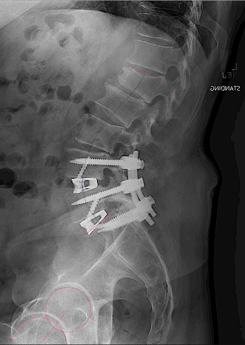 Medtronic Cranial & Spinal Technologies | Featured Cases | Daniels